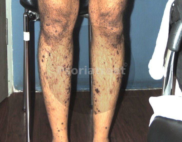 Lichen Planus Treatment