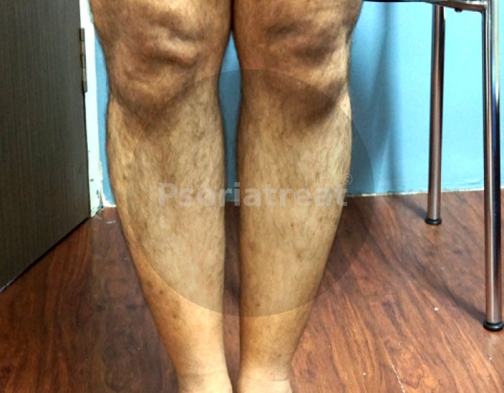 Lichen Planus Treatment