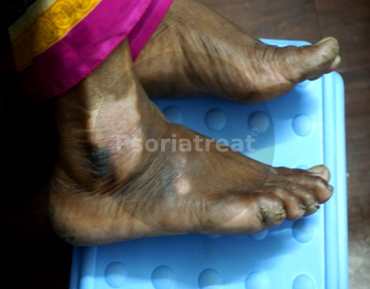 vitiligo causes vitiligo treatment