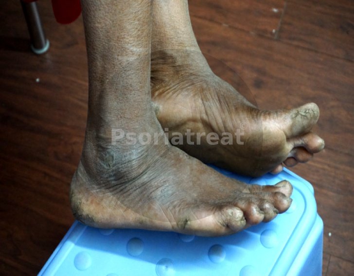 vitiligo causes vitiligo treatment