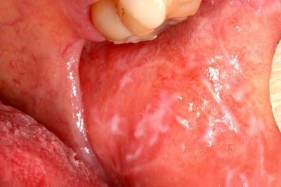 Lichen Planus Oral