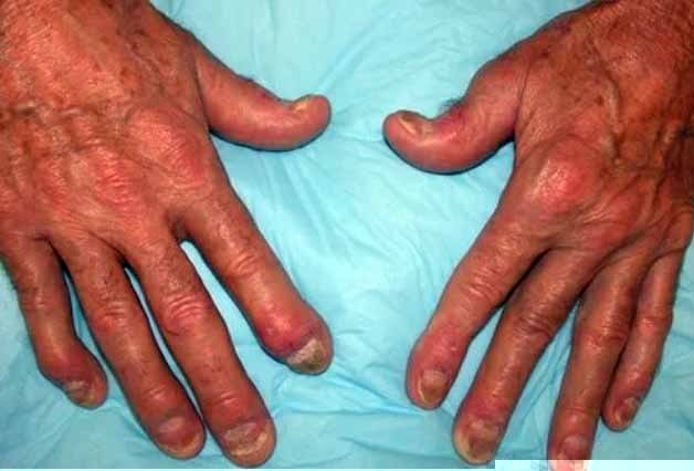 psoriatic arthritis
