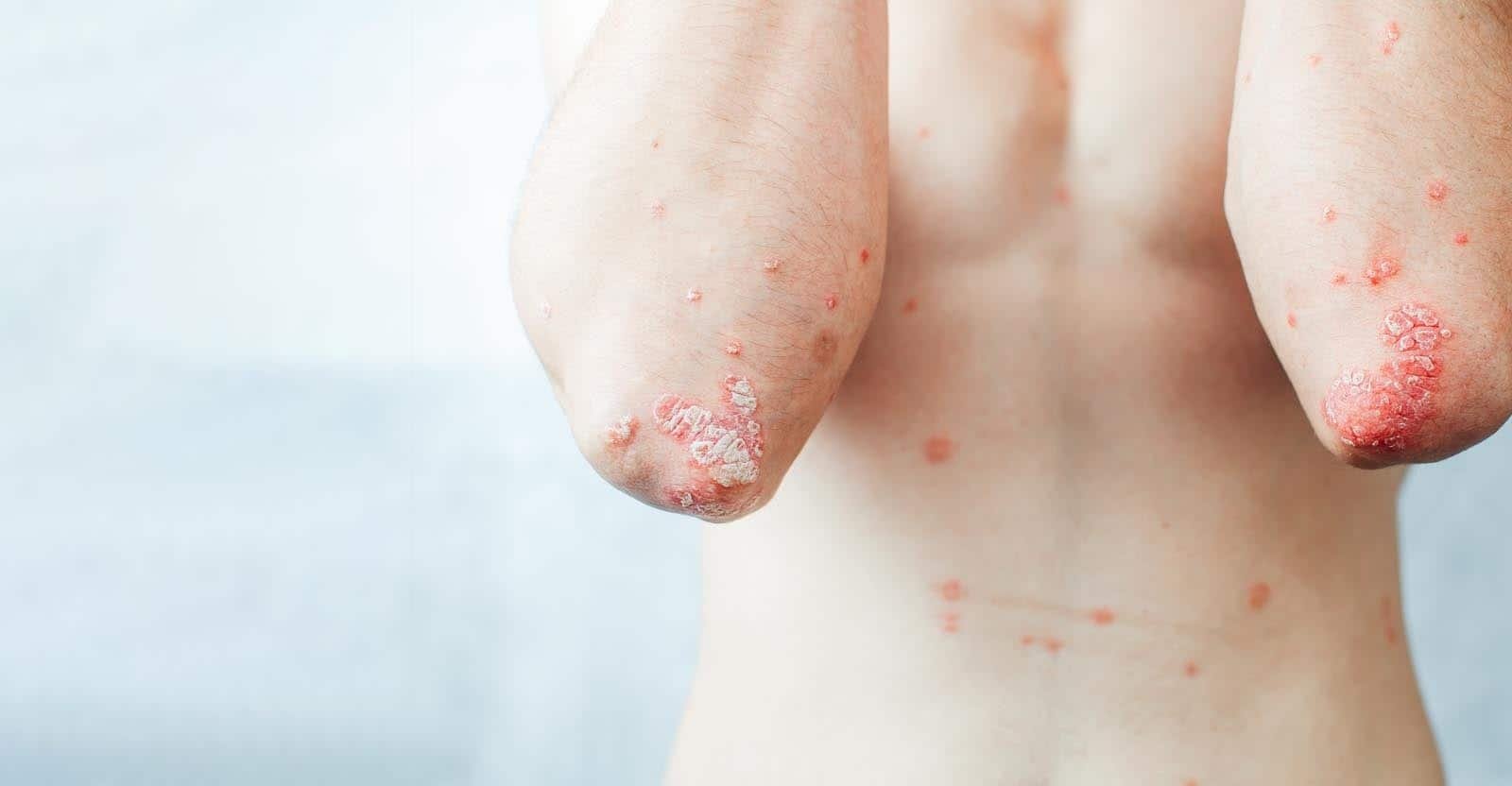 psoriasis treatment