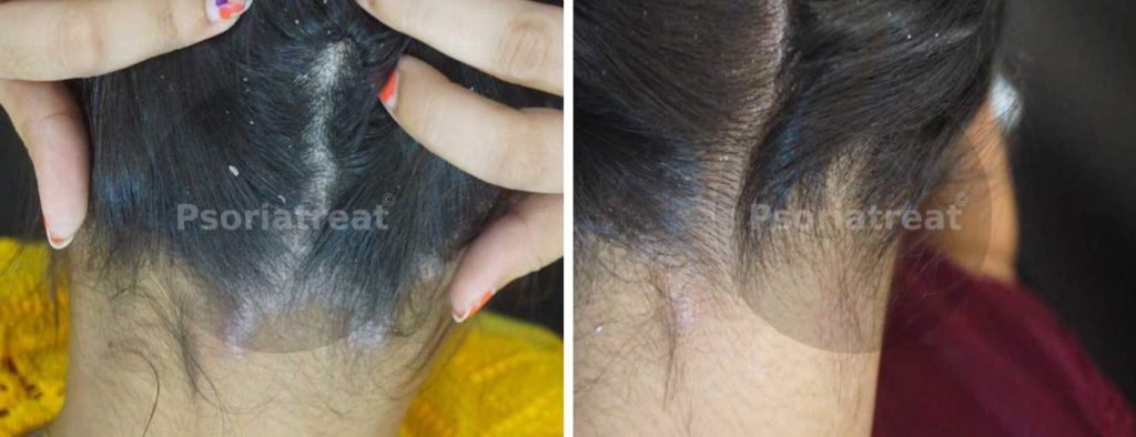 Scalp Psoriasis