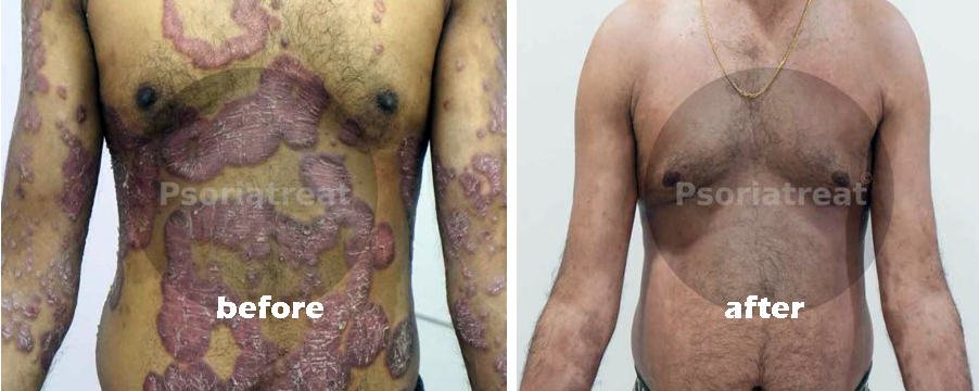 Plaque Psoriasis Treatment