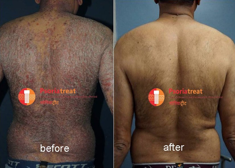 erythrodermic psoriasis