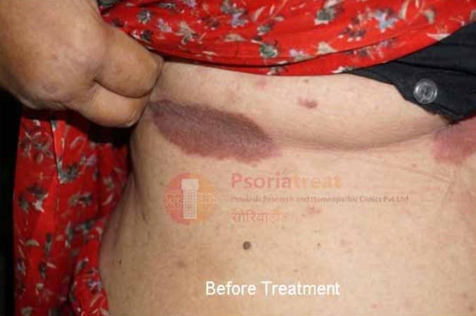 Inverse Psoriasis