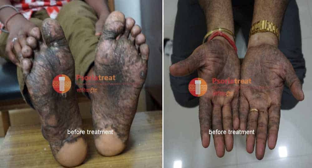 Plantar Psoriasis Treatment