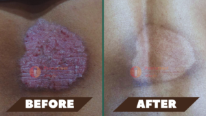 chronic plaque psoriasis treatment
