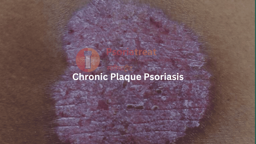 chronic plaque psoriasis treatment