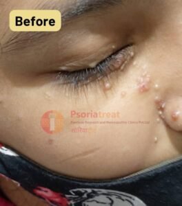 molluscum contagiosum on face of child