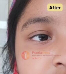 molluscum contagiosum on face of child