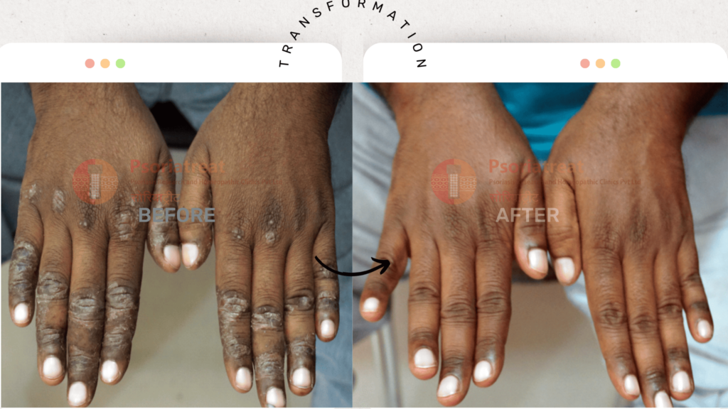 palmoplantar psoriasis treatment palmoplantar psoriasis treatment