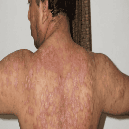 before psoriasis treatment photo
