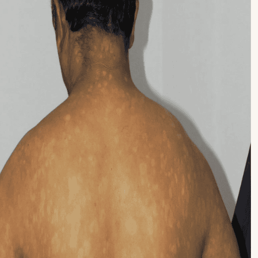 after psoriasis treatment photo