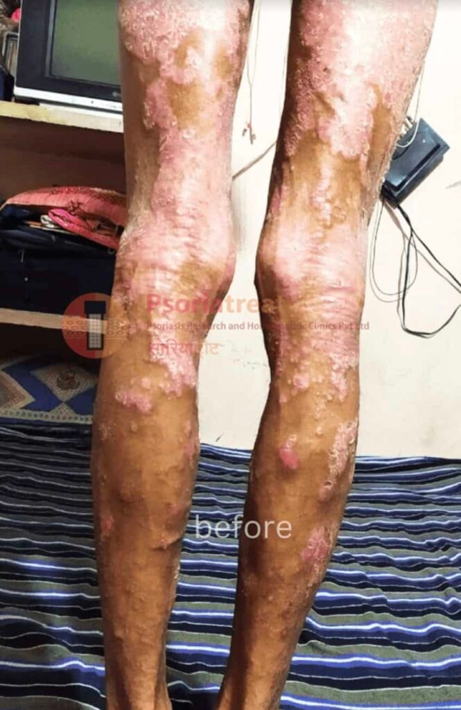 severe psoriasis treatment severe psoriasis treatment