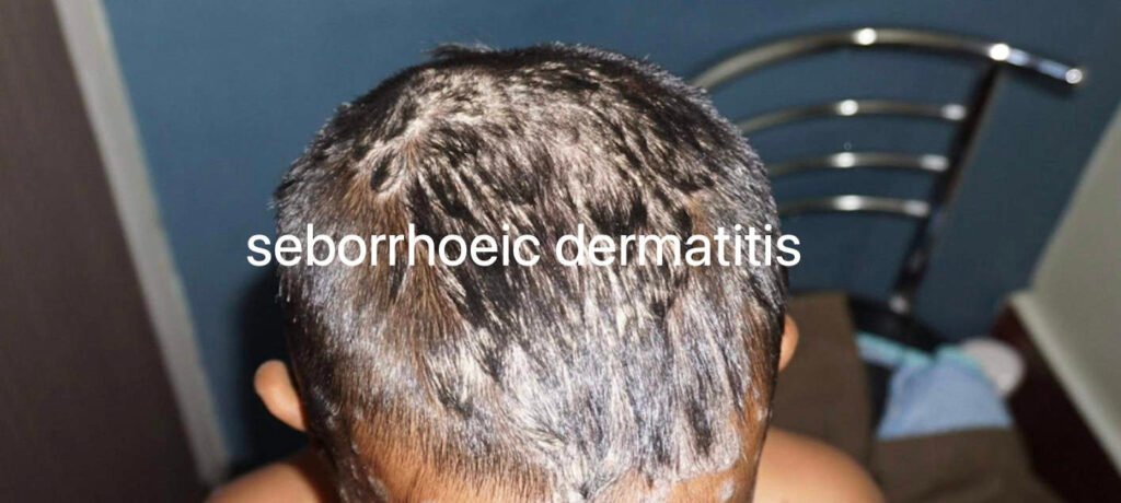 seborrhoeic dermatitis treatment at home