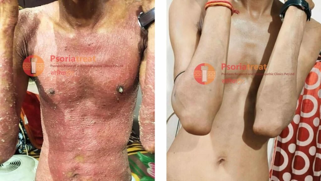 severe psoriasis treatment options severe psoriasis treatment options