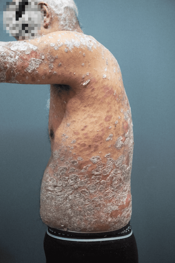 erythrodermic psoriasis erythrodermic psoriasis