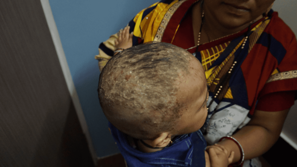 psoriasis in child