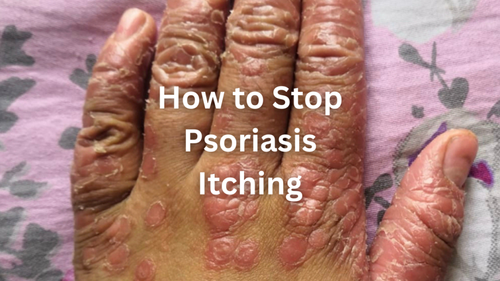 How to Stop Psoriasis Itching