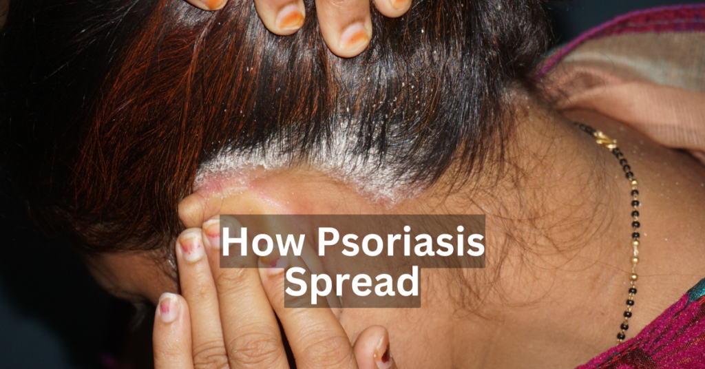 how psoriasis spread