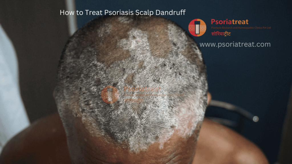 how to treat psoriasis scalp dandruff